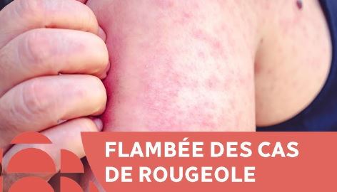 une flambée dramatique de rougeole au Maroc: défaillances structurelles ou responsabilité collective?